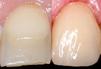 Links: Zahn mit großer insuffizienten Füllung; Rechts: Schneidezahn mit einer vollkeramischen Krone…