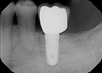 Röntgenbild mit einem Implantat mit Krone.…